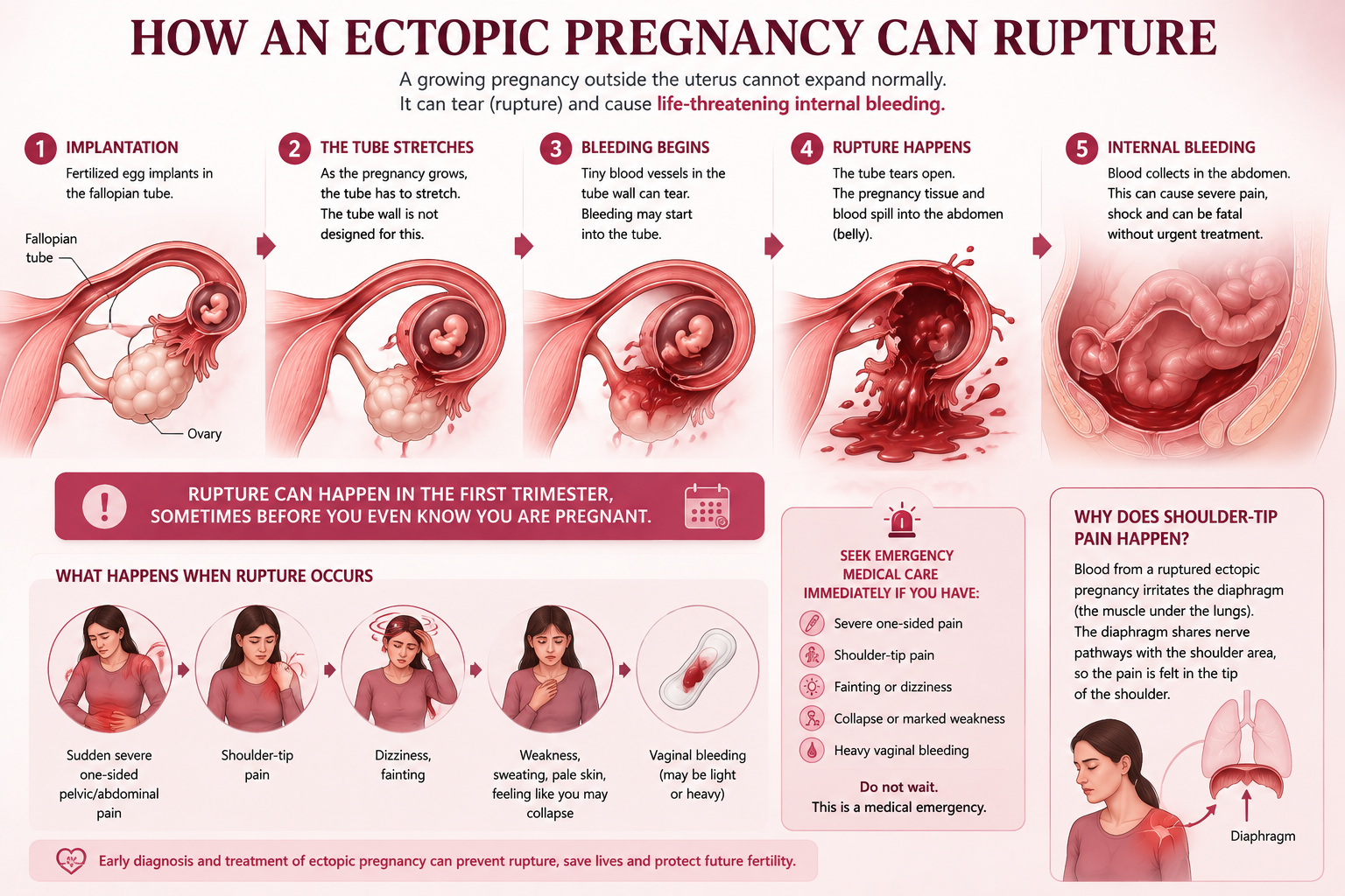 How a tubal ectopic pregnancy grows stretches the fallopian tube ruptures and causes internal bleeding