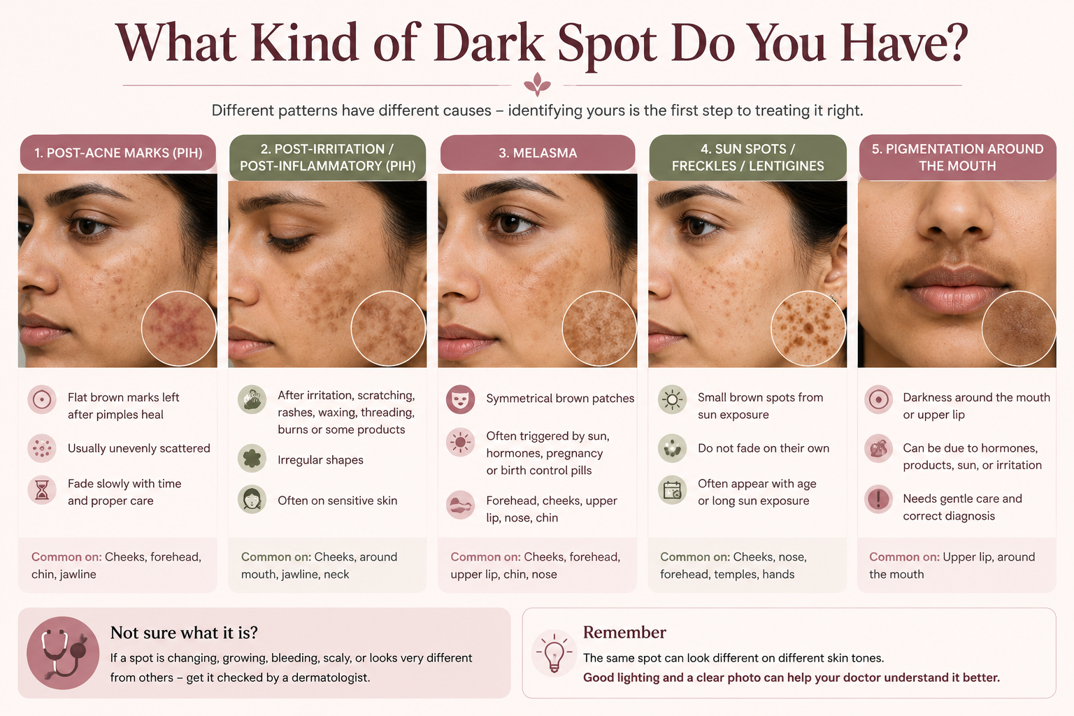 Different types of dark spots on the face including acne marks melasma sun spots and post-inflammatory hyperpigmentation