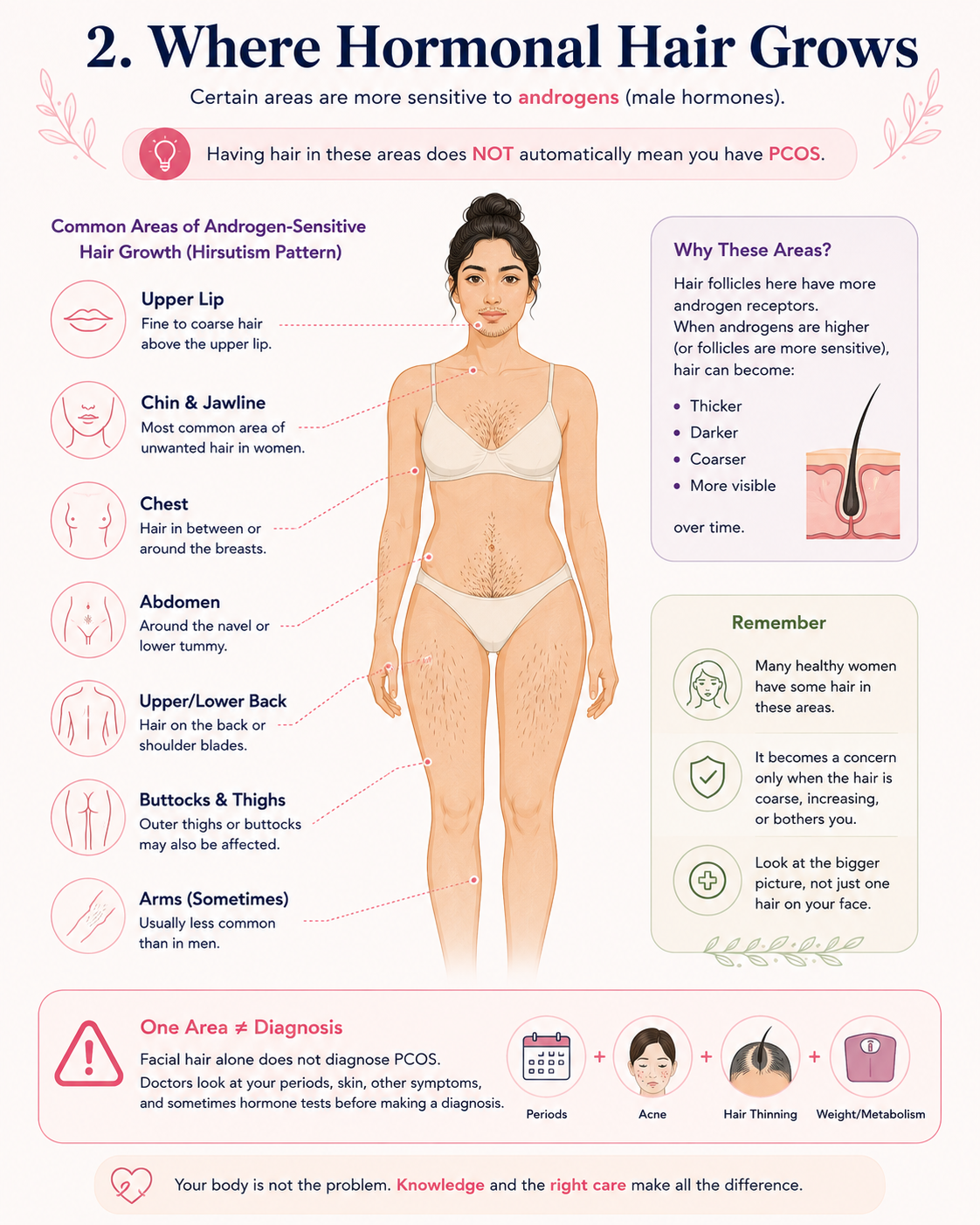 Androgen-sensitive areas of excessive hair growth in women including upper lip, chin, chest, abdomen and back