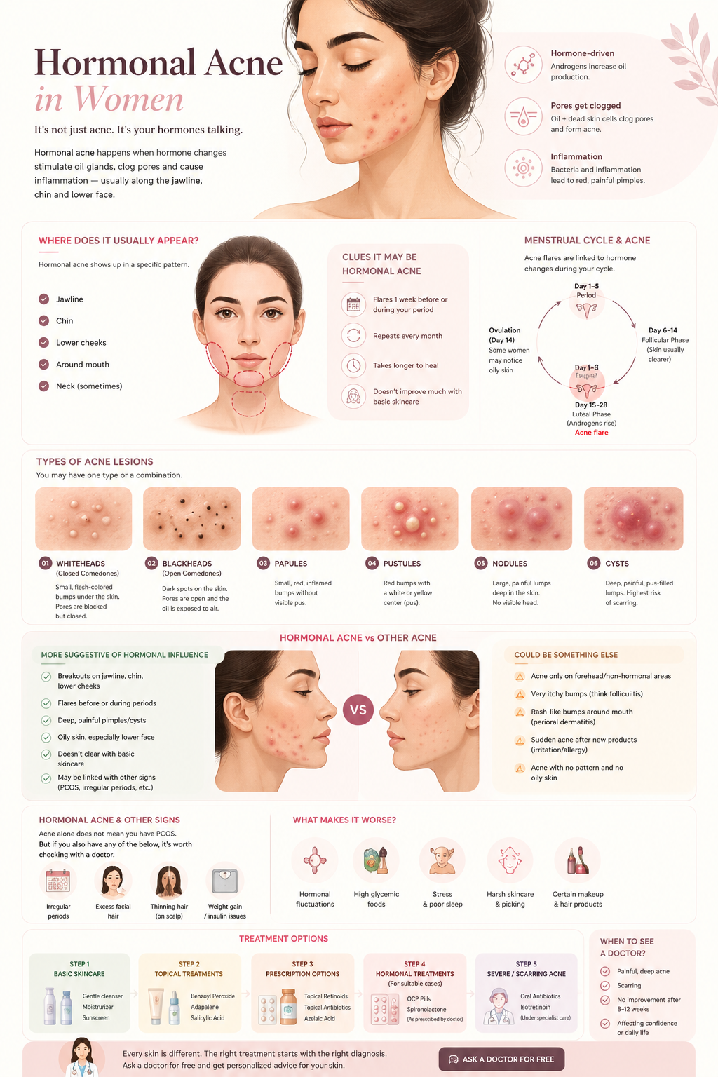 Medical illustration explaining hormonal acne in women, acne locations, menstrual cycle patterns and different acne lesion types
