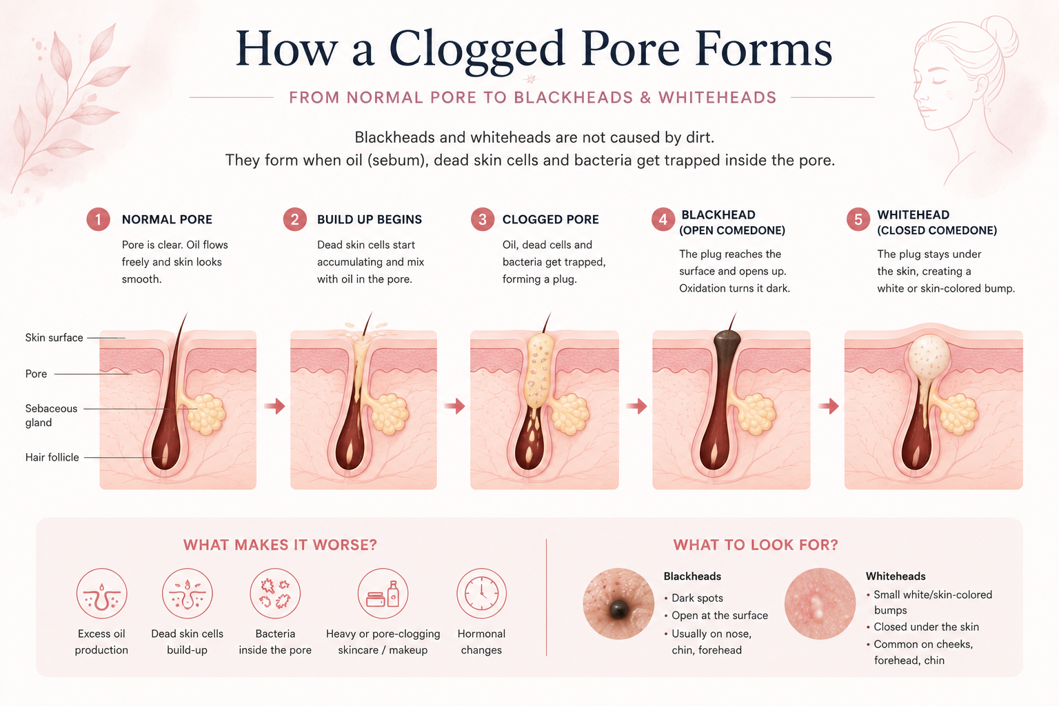 Medical illustration explaining how a clogged pore forms and develops into a blackhead or whitehead