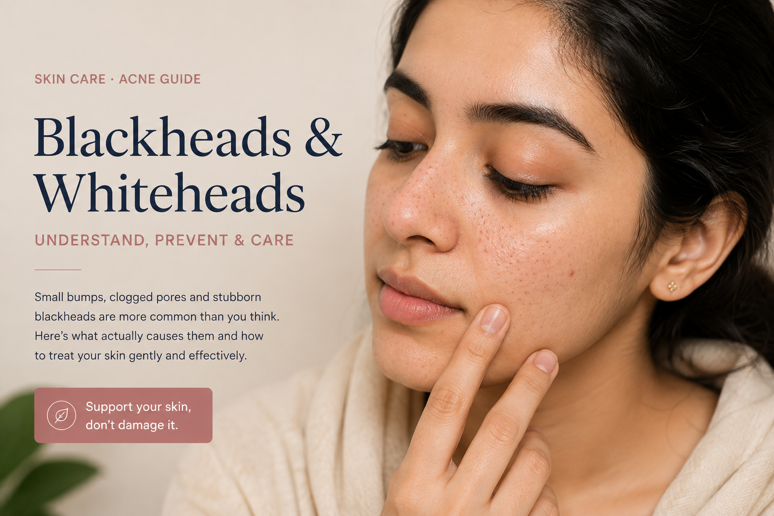 Blackheads and whiteheads acne guide