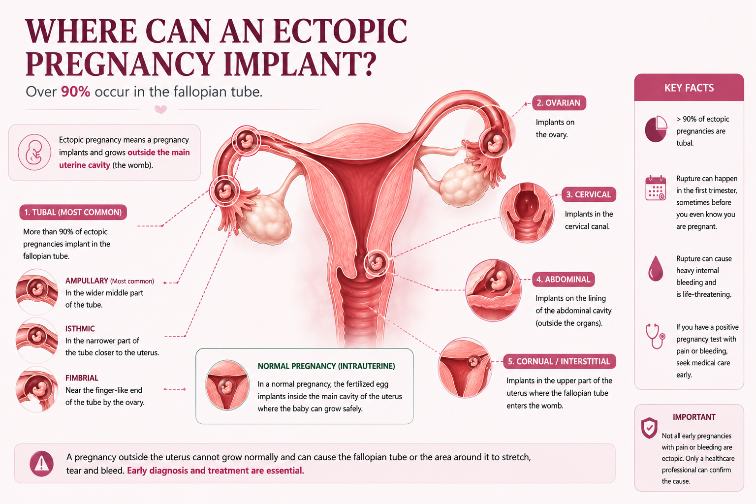 Possible locations of an ectopic pregnancy including tubal ovarian cervical interstitial and abdominal ectopic pregnancy