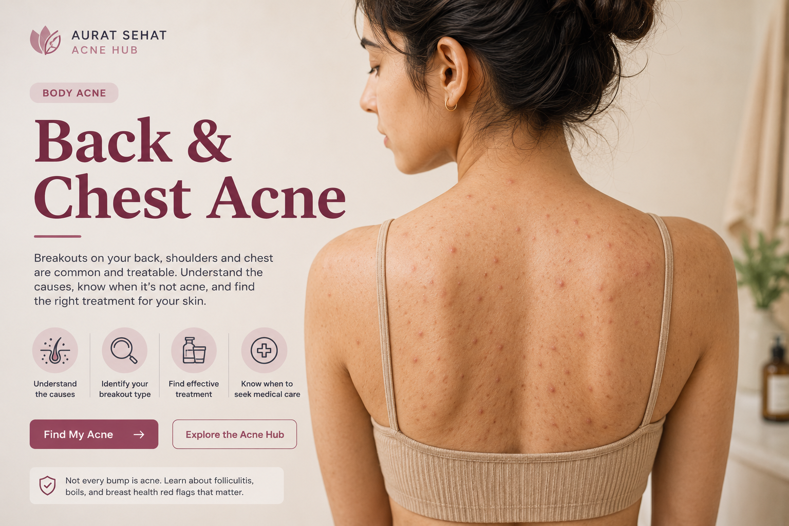 Back and chest acne on an adult woman