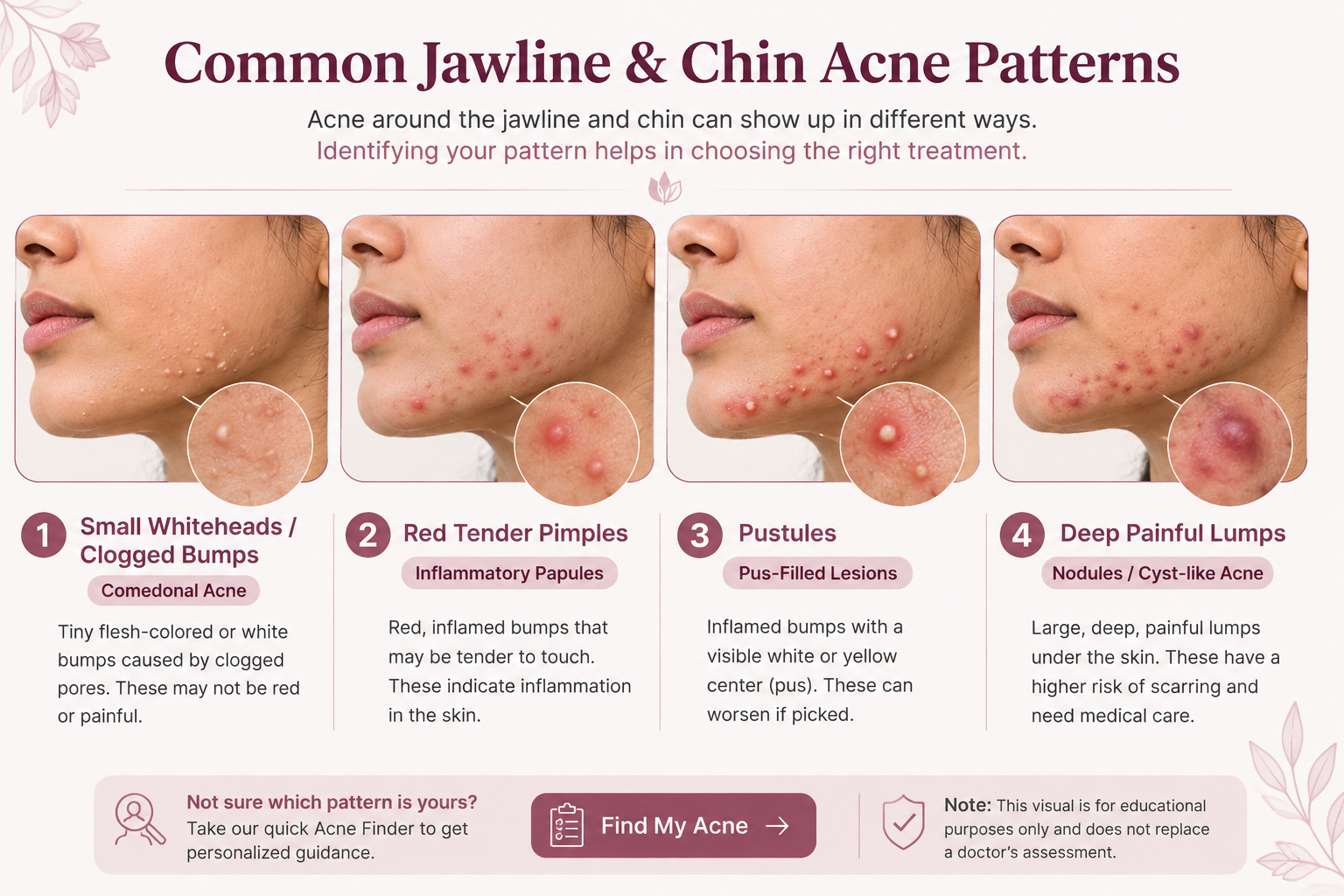 Common patterns of jawline and chin acne