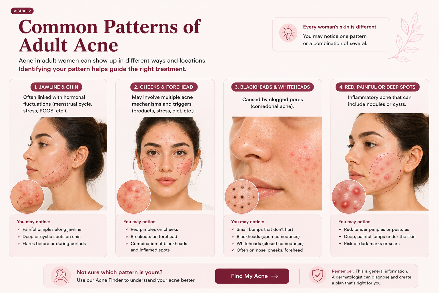Common patterns of adult acne in women