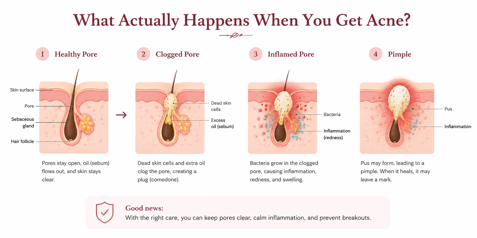 Medical illustration showing how a normal pore becomes clogged and inflamed