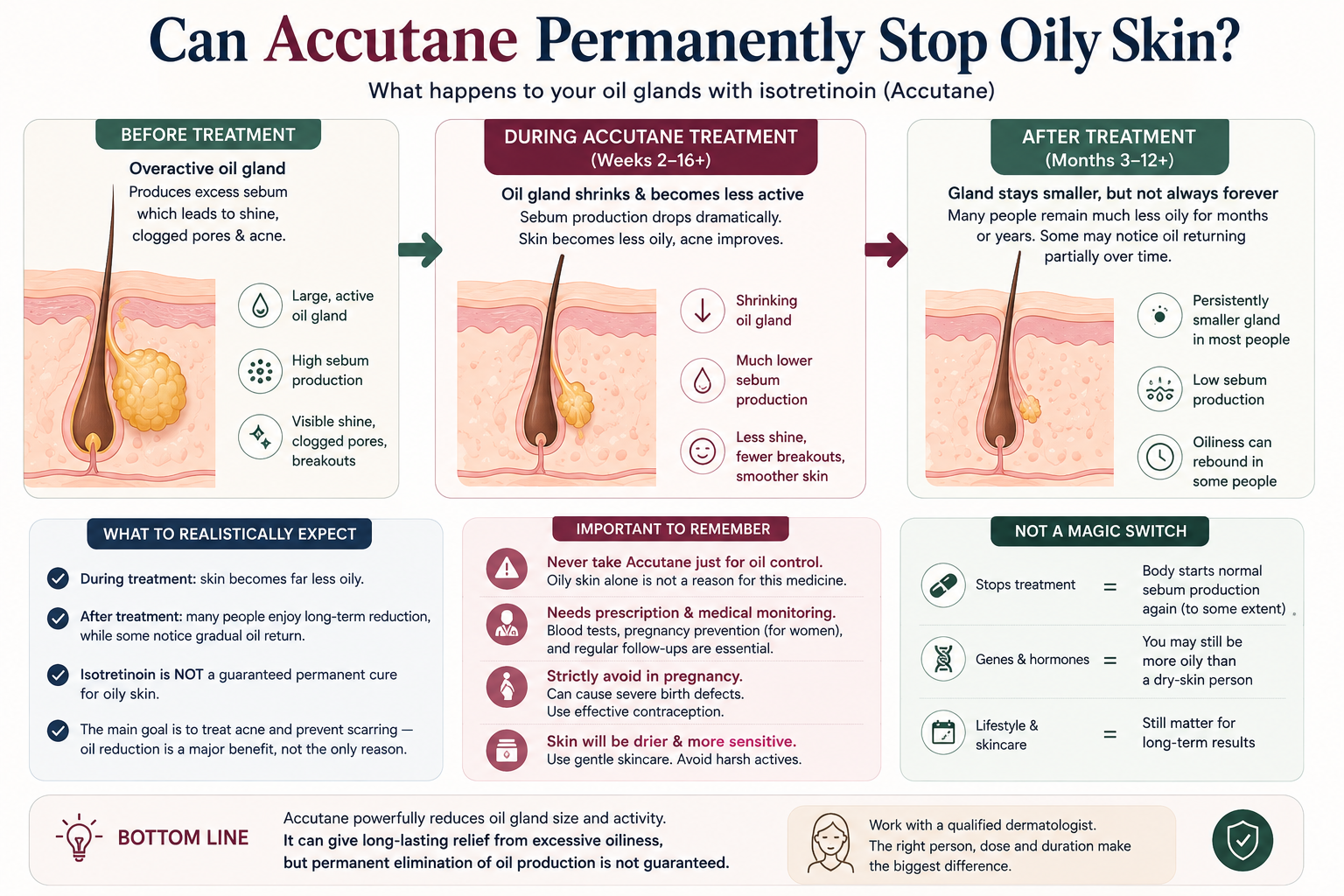 Diagram showing sebaceous oil glands before, during and after isotretinoin treatment and why oily skin may return after stopping.