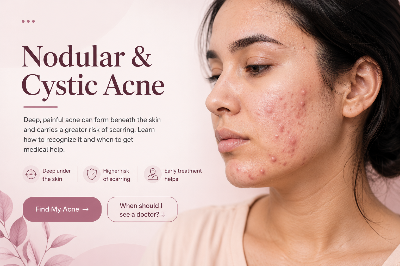 Nodular and cystic acne on the face